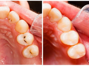Teeth Before and After Dental Treatment.