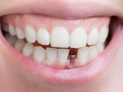 Implant Dentistry