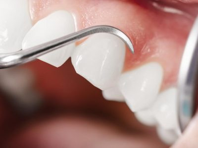 Periodontal Treatment