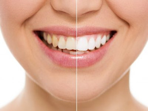 Cosmetic Dental Treatment Result